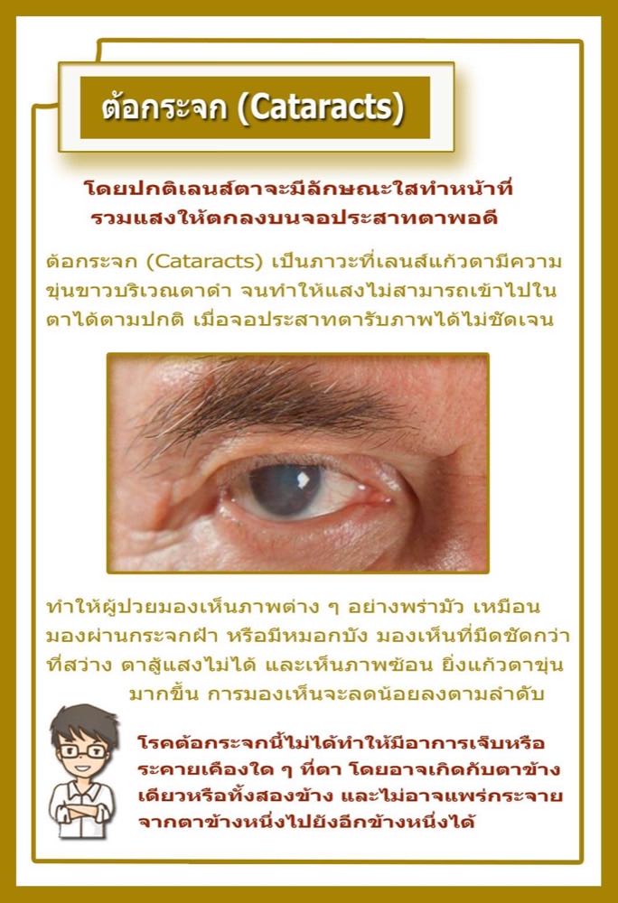 ต้อกระจก