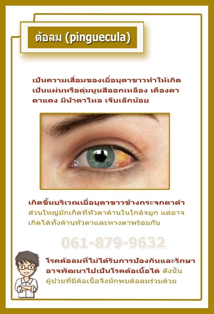 ต้อลม