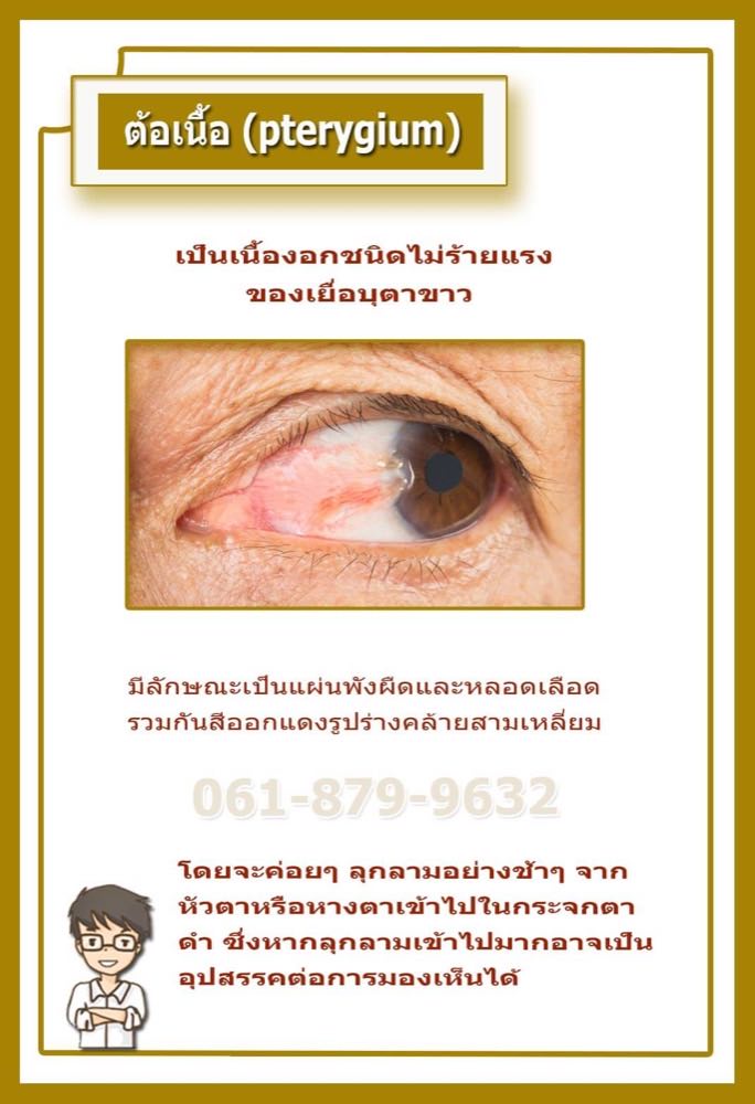 ต้อเนื้อ